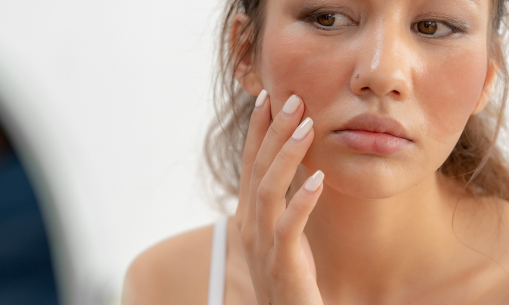 Laat voeding jouw rosacea-remedie zijn