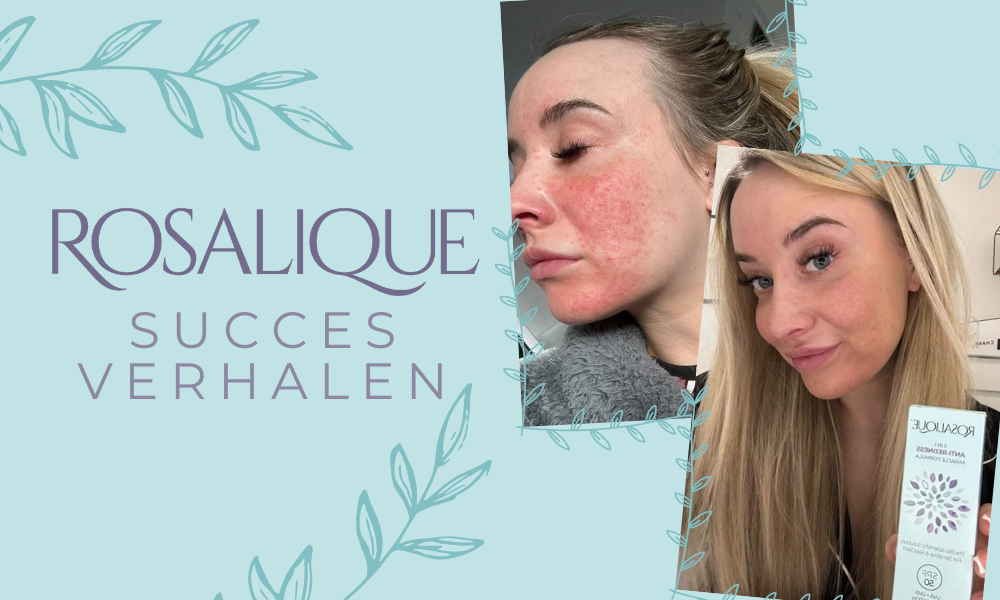Rosacea Awareness Month- Rosacea succesverhalen