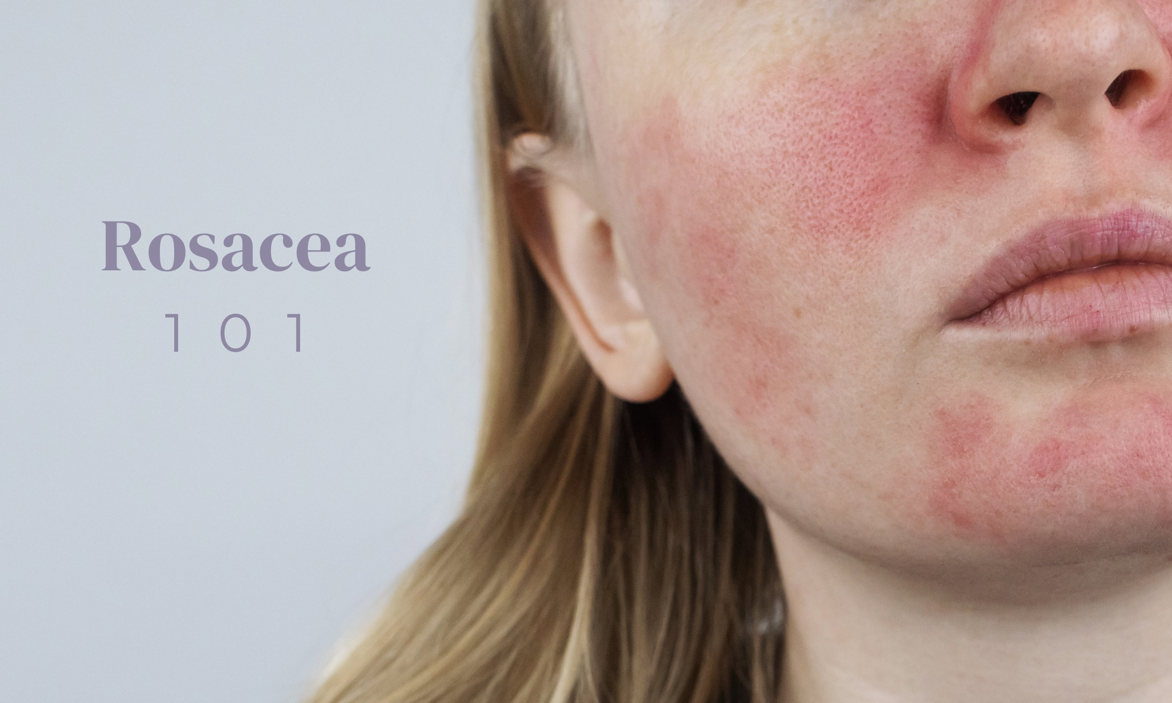 Rosacea 101