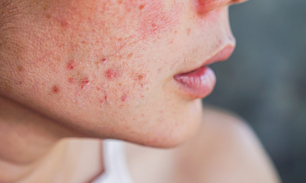 De ins en outs van acne rosacea