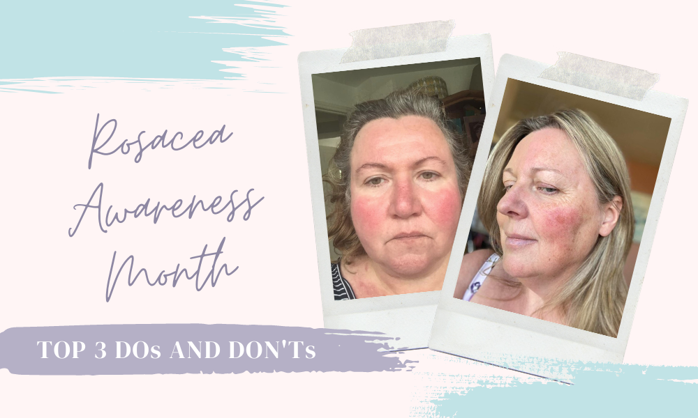 Rosacea Awareness Month