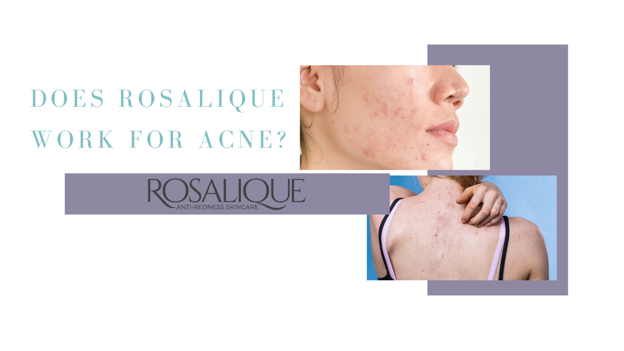 Werkt Rosalique tegen acne?