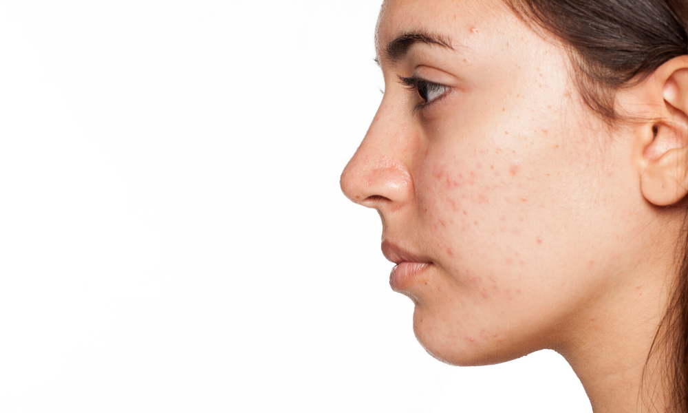 Acne Awareness Month, Wat is Acne?